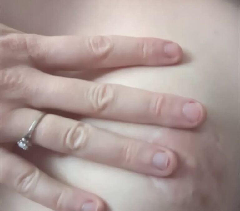 The fingers of Kori's left hand touch scars.